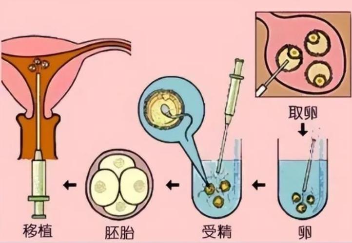 北京供卵试管婴儿(北京供卵试管婴儿:打破生育障碍的新选择)